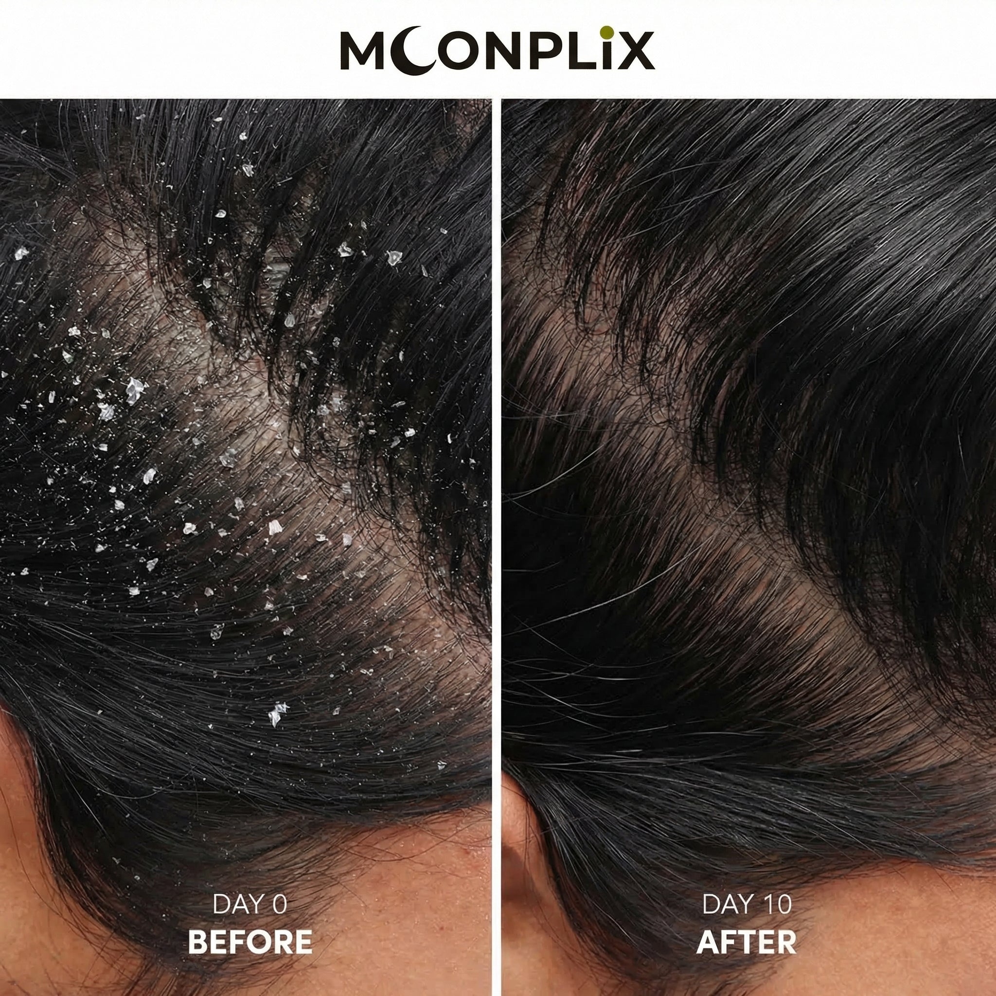 Moonplix Anti Dandurff Shampoo